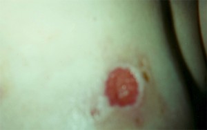 Breast Eschar Falls Off