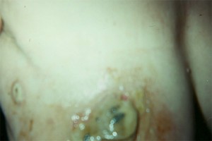 Eschars Form on Breast