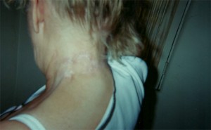 Neck Healed